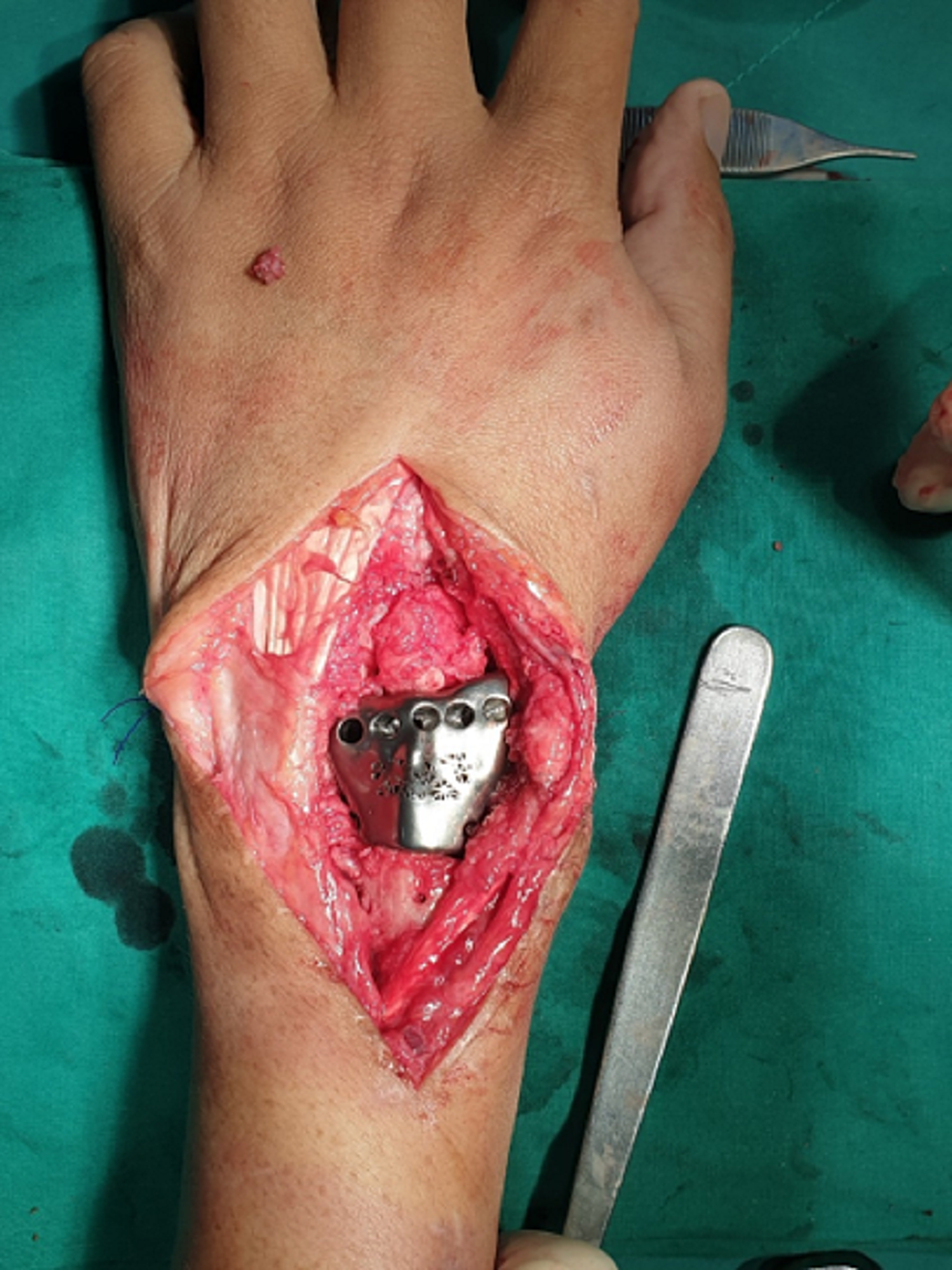 Placement-of-the-customized-distal-radius-prosthesis