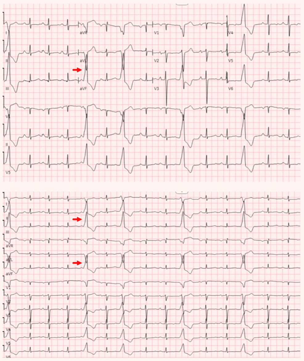 Titin Cardiomyopathy Associated With Refractory Ventricular Tachycardia: A  Case Report | Cureus