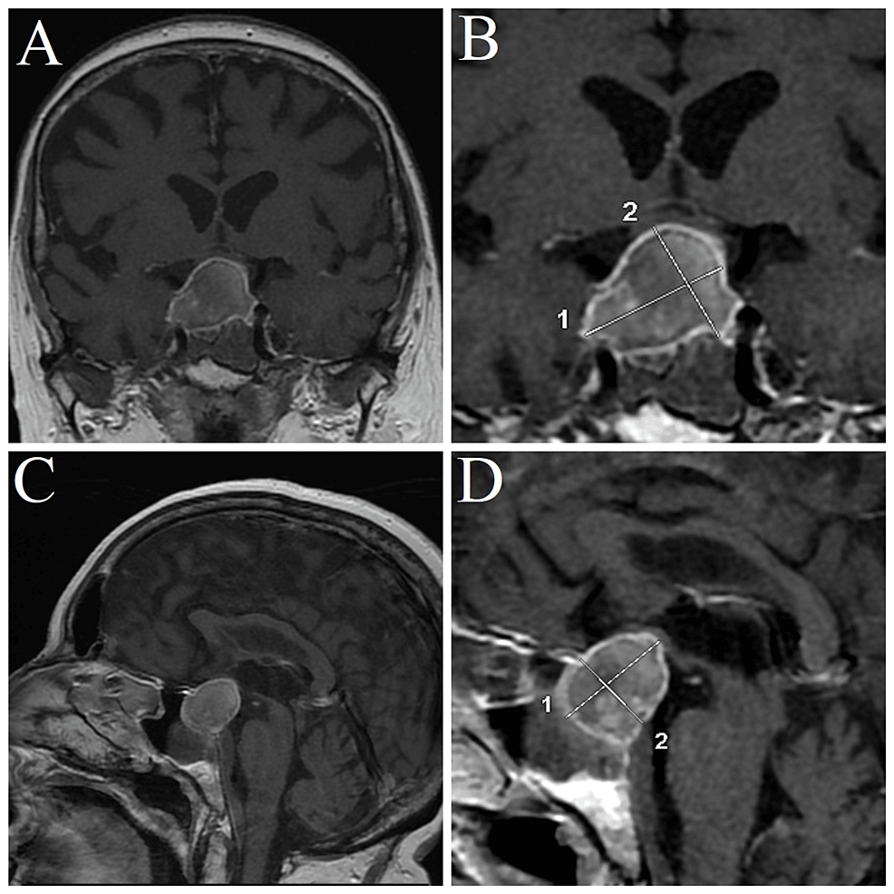 a-complex-case-of-pituitary-apoplexy-mimicking-a-stroke-a-case-report