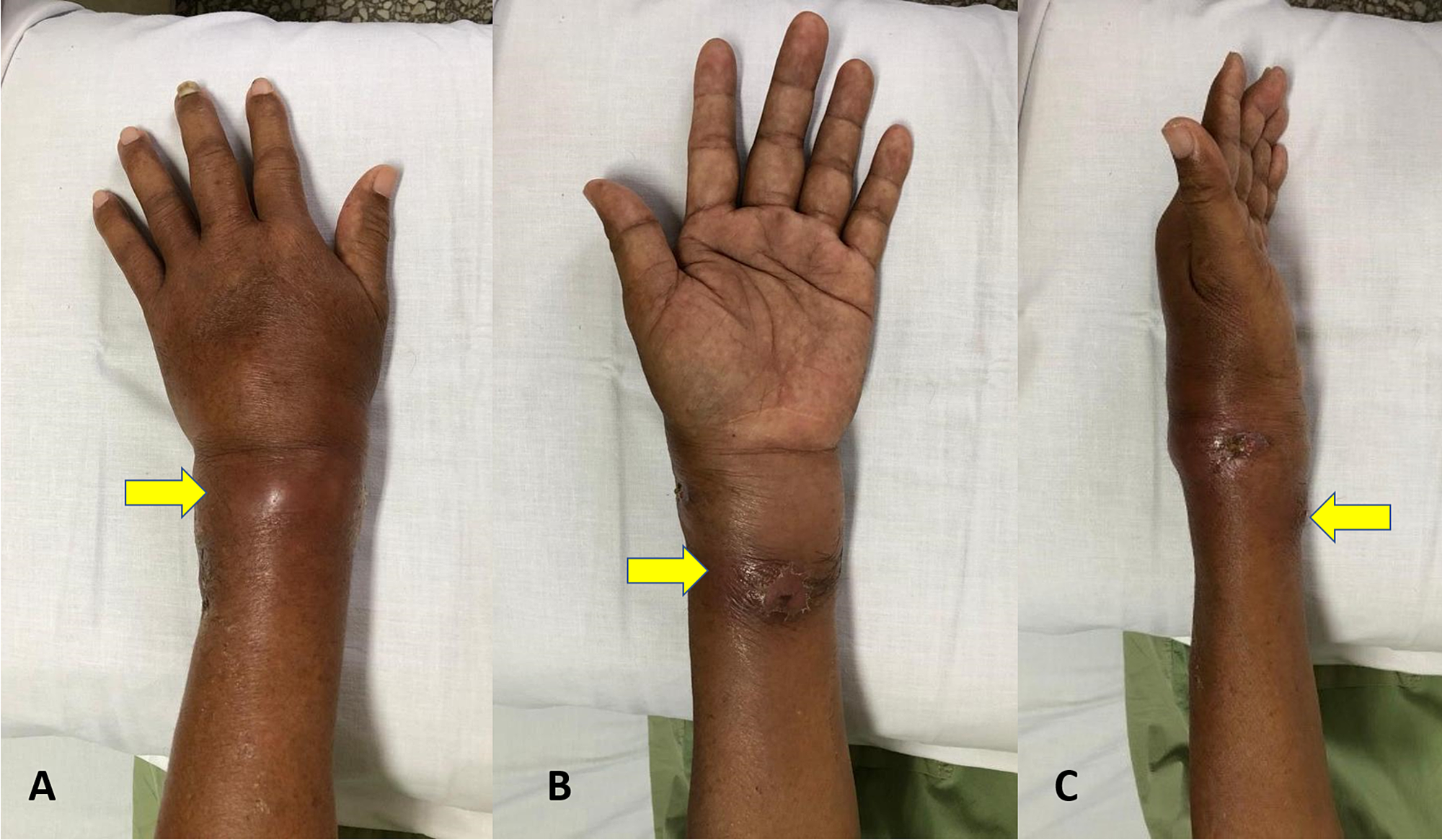 Cureus | Isolated Tuberculosis Of The Wrist: Subtle But Destructive