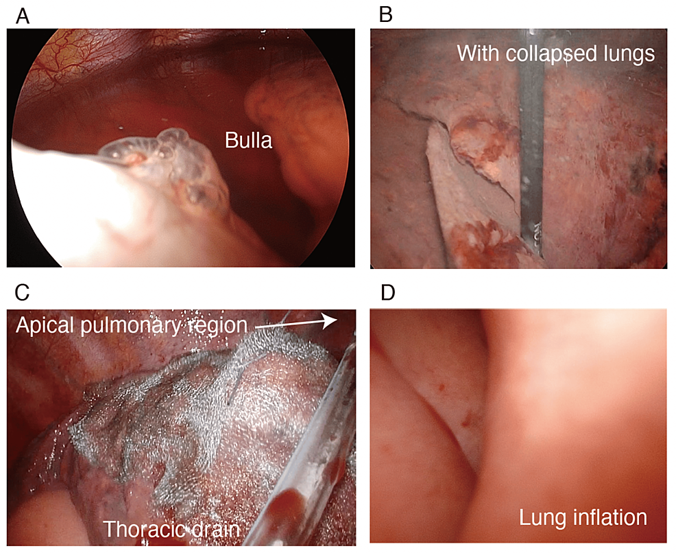 Thoracoscopic-findings.-