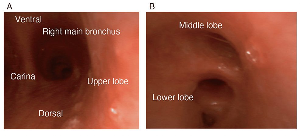 Bronchoscopic-findings.