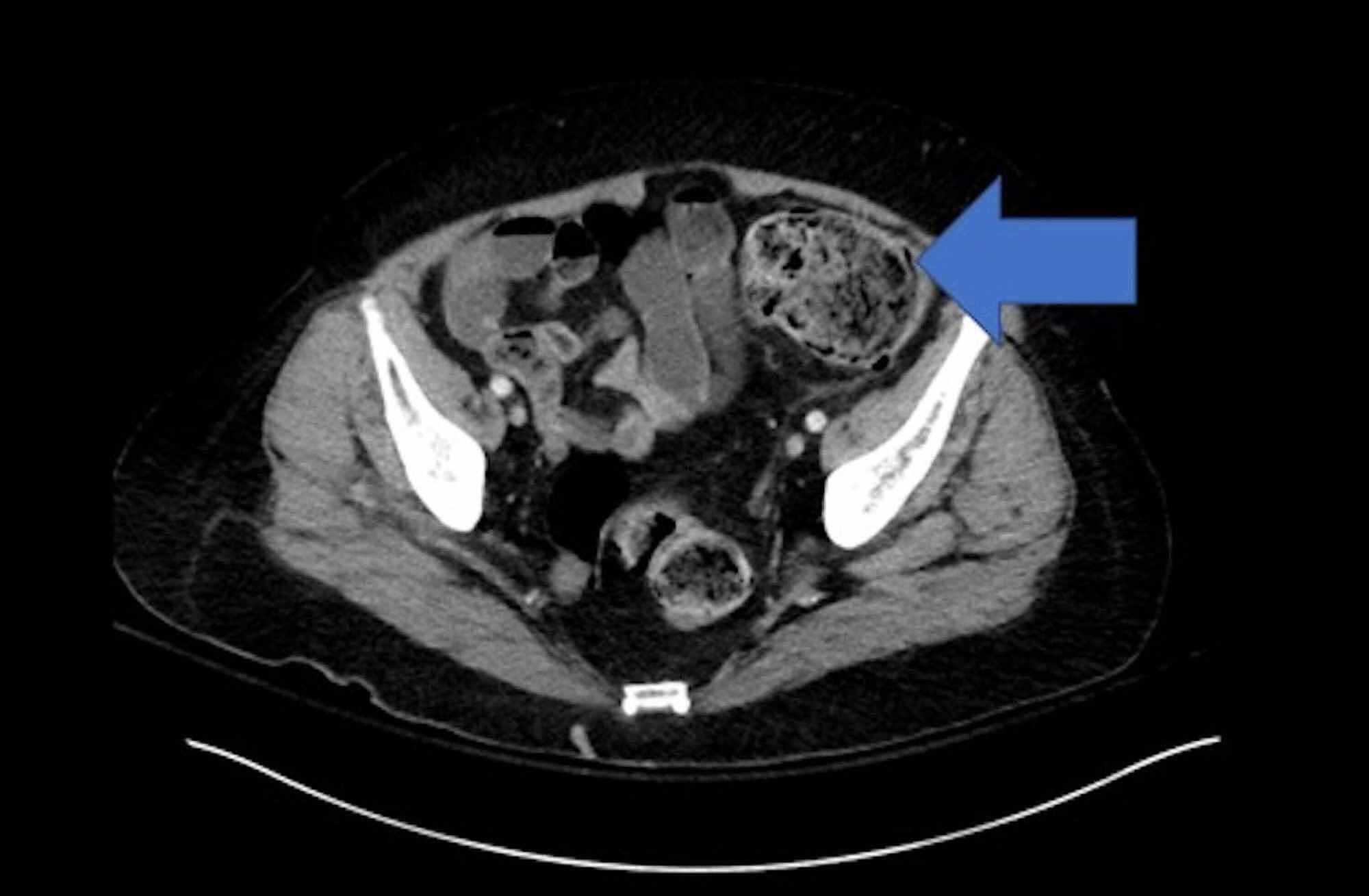 Cureus Fulminant Ischemic Pancolitis A Severe Variant of Ischemic