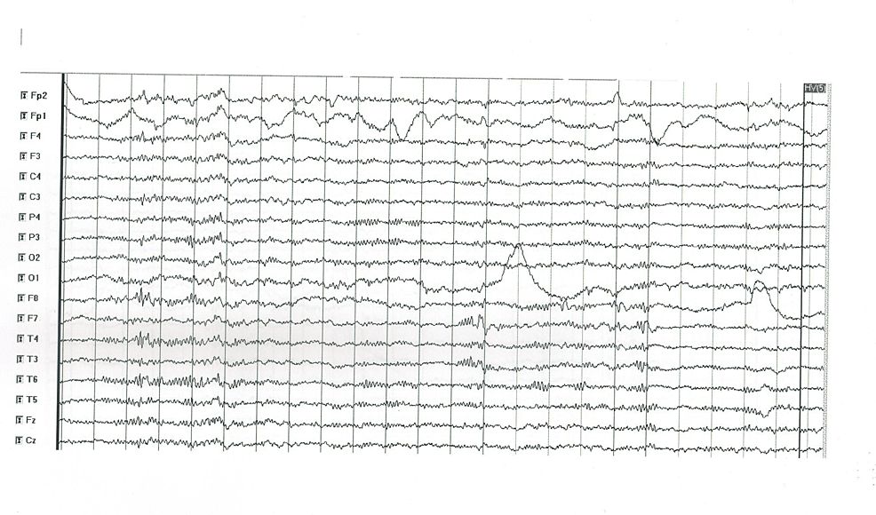 EEG-abnormal-findings-in-patient-1