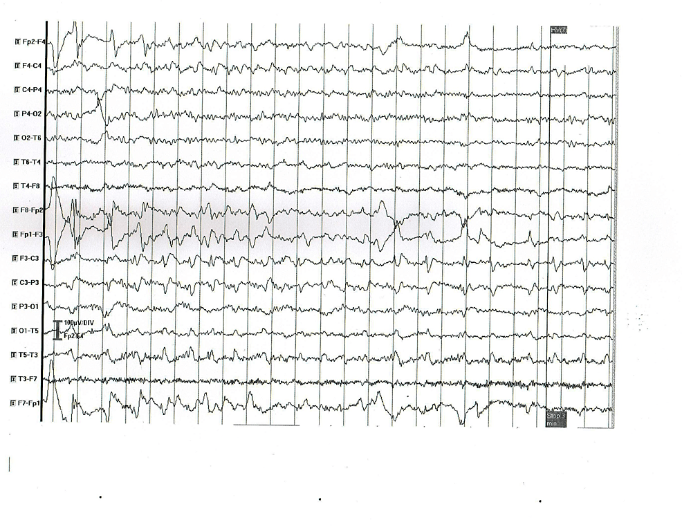 EEG-abnormal-findings-in-patient-2