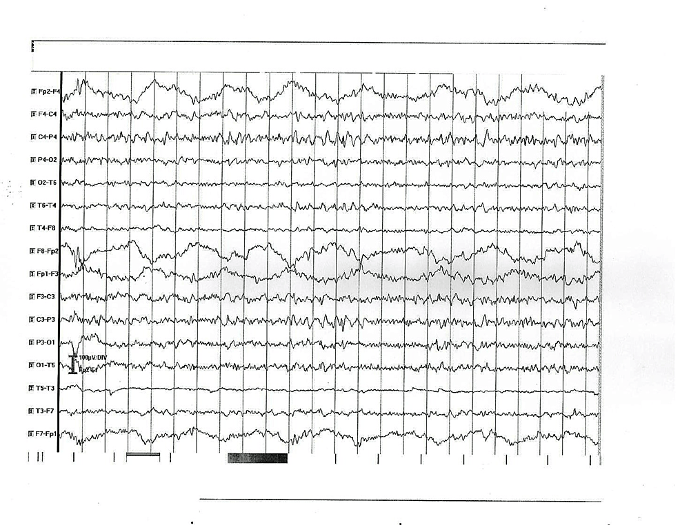 EEG-abnormal-findings-in-patient-4