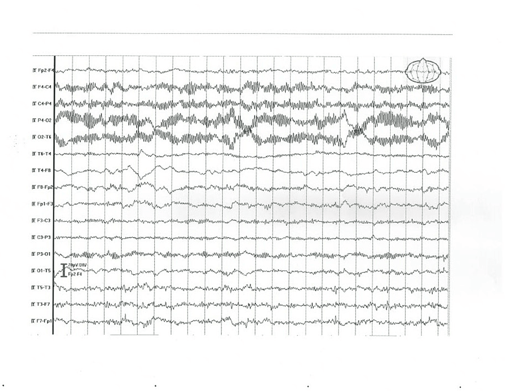 EEG-abnormal-findings-in-patient-5