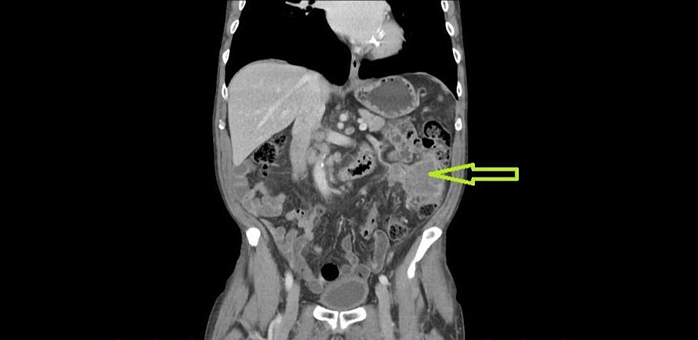 Cureus Primary Squamous Cell Carcinoma Of The Descending Colon   Article River C62cc930845211ea8857791c40b9a8d3 CT CHEST ABDO PELVIS SCC 