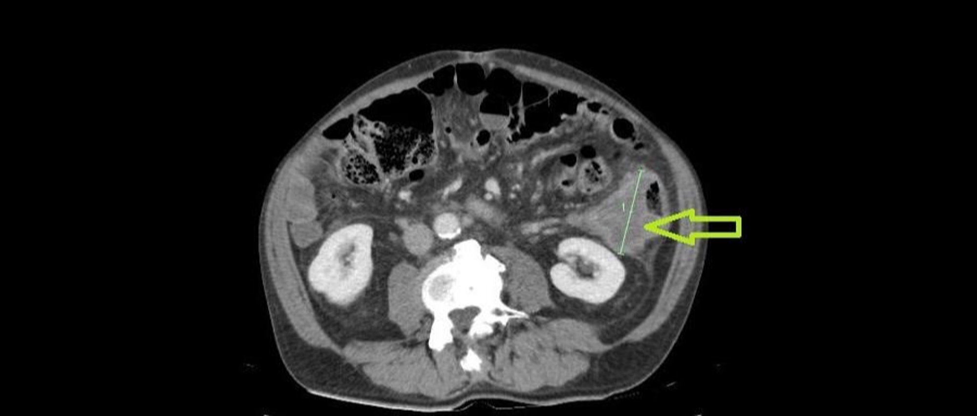 Cureus Primary Squamous Cell Carcinoma Of The Descending Colon