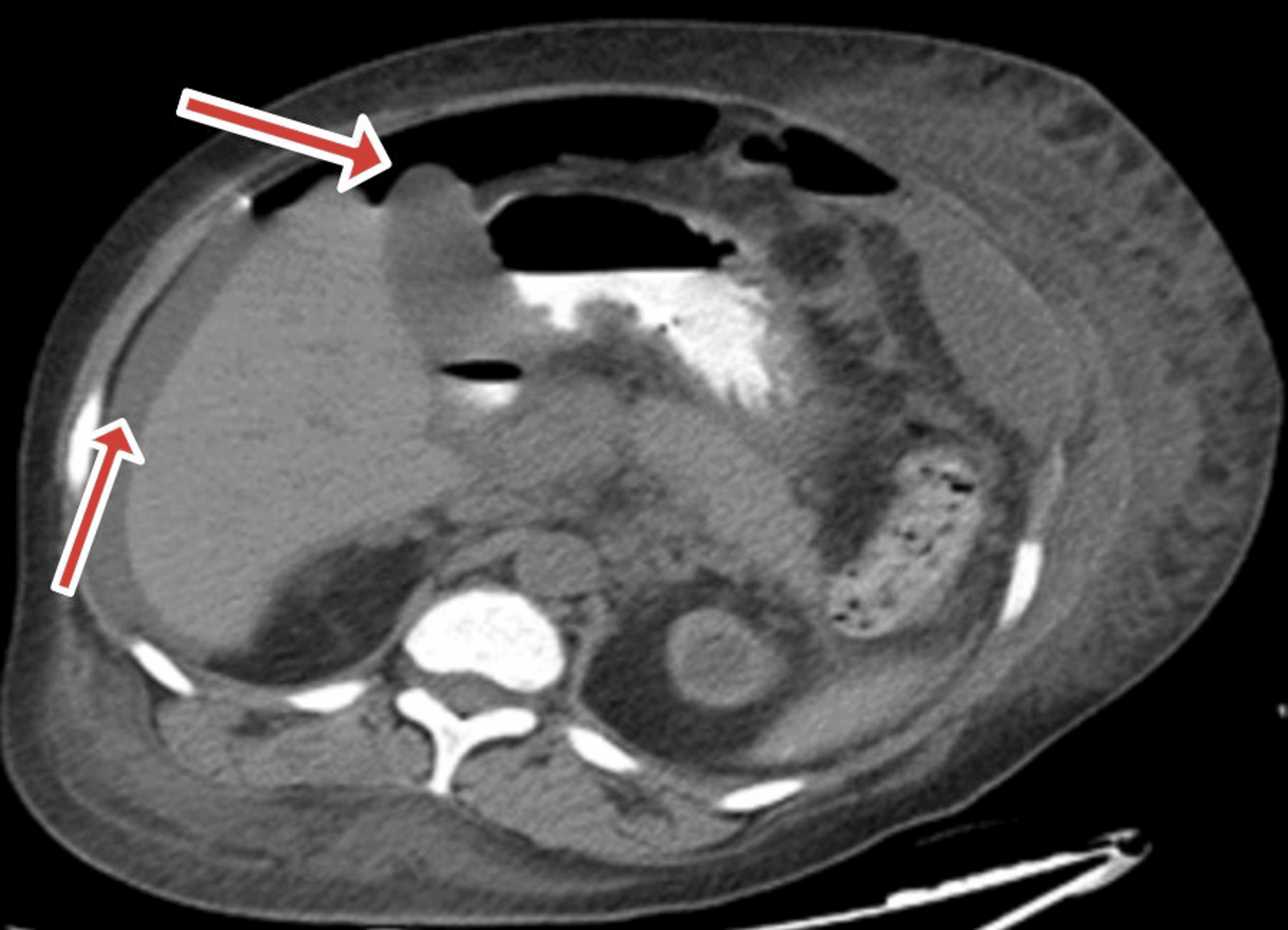 Cureus Small Bowel Ischemia and Ischemic Colitis Secondary to Thrombotic Thrombocytopenic