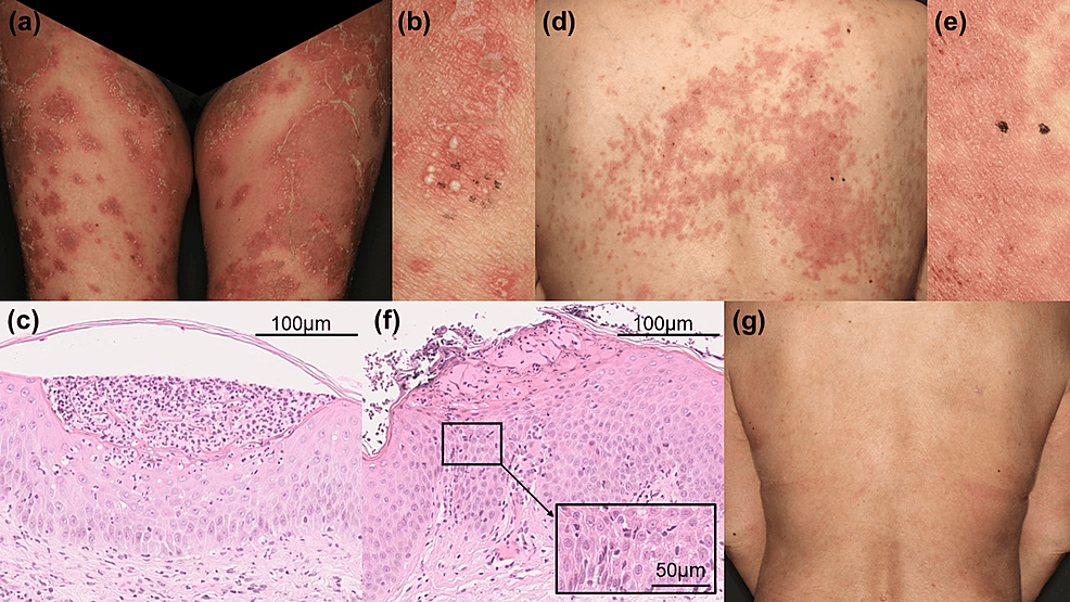 glutathione eczema Glutathione S-transferase Mu 1 elisa kit | Rat Glutathione S-transferase Mu  1 ELISA Kit main image 0