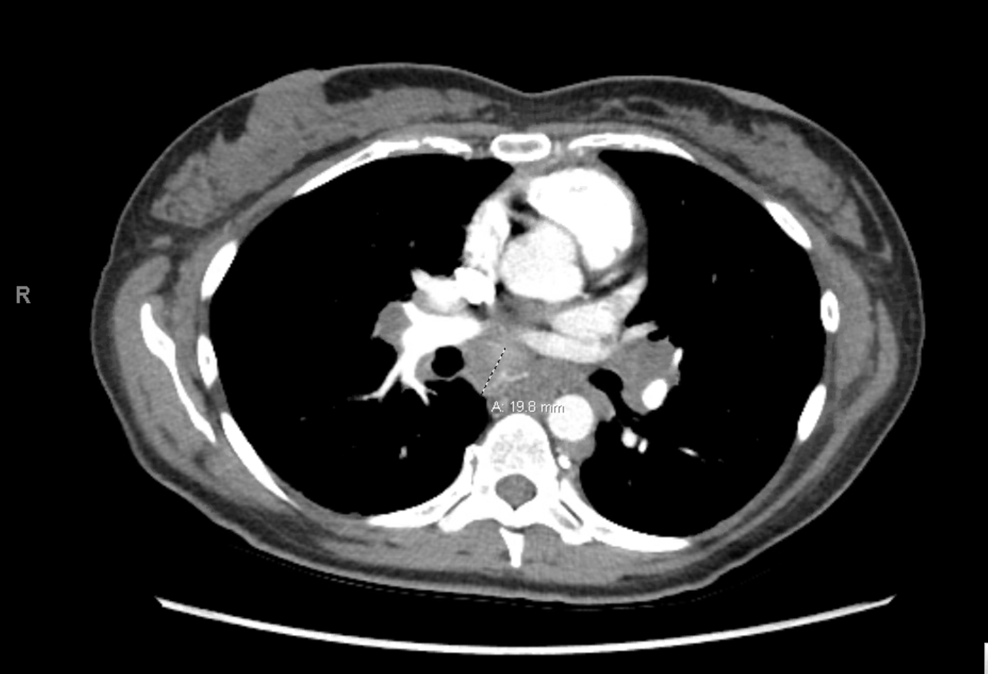 Cureus | Pancreatic Sarcoidosis: A Very Rare Presentation of the Disease