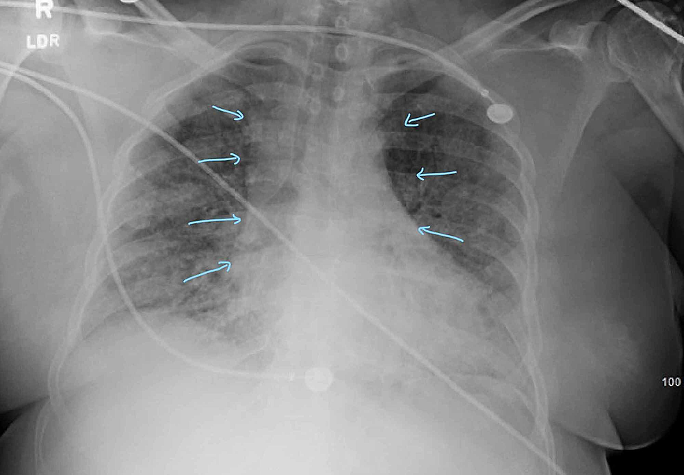 Cureus | Corona Virus Disease 2019 (COVID-19) Presenting as Acute ST ...