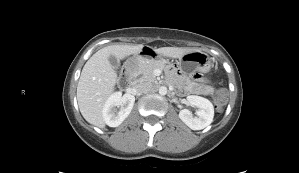 Cureus | Pancreatic Sarcoidosis: A Very Rare Presentation of the Disease