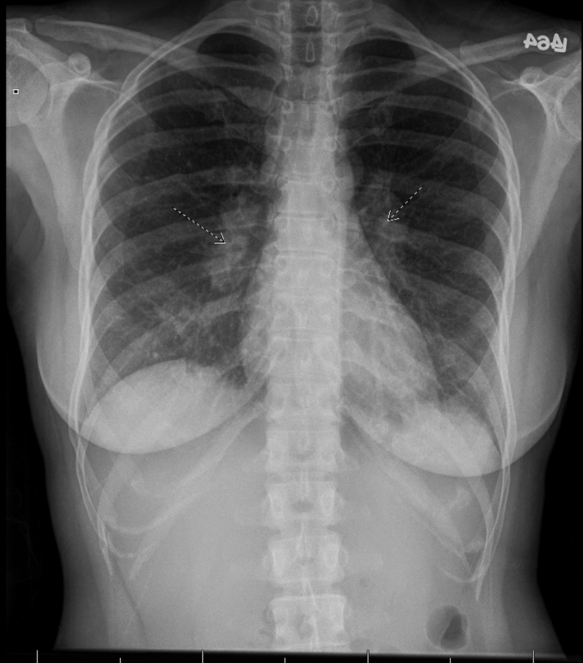 Chest X Ray Showing Bilateral Hilar Lymphadenopathy In A Patient With ...