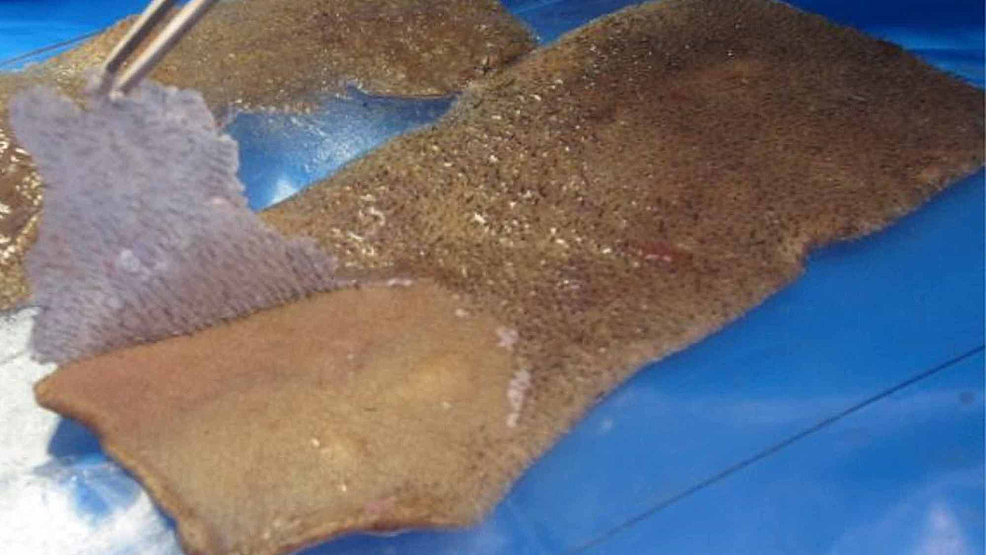 Cureus A Simple Technique for Intraoperative Scalp Skin Graft Depilation Using Dermabond®