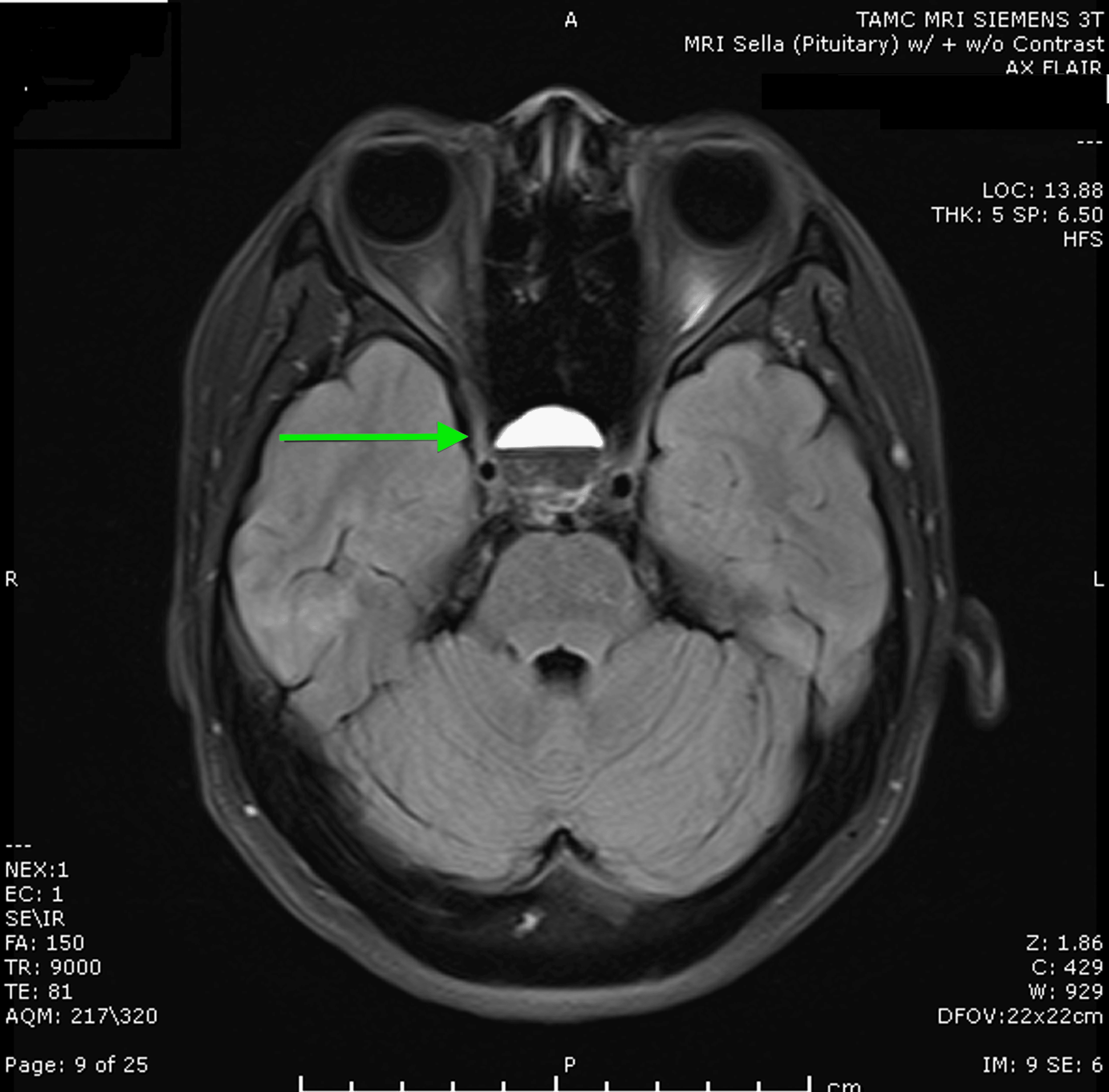 Severe Hyponatremia Secondary to Pituitary Macroadenoma With Internal ...