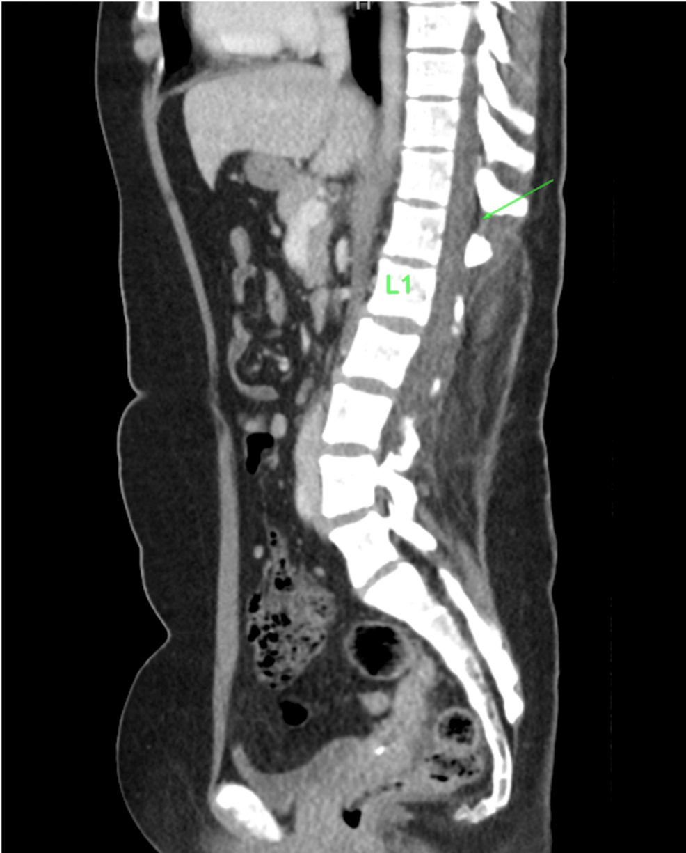 Sagittal-computerized-tomography-scan-of-abdomen,-arrow-indicates-possible-epidural-space