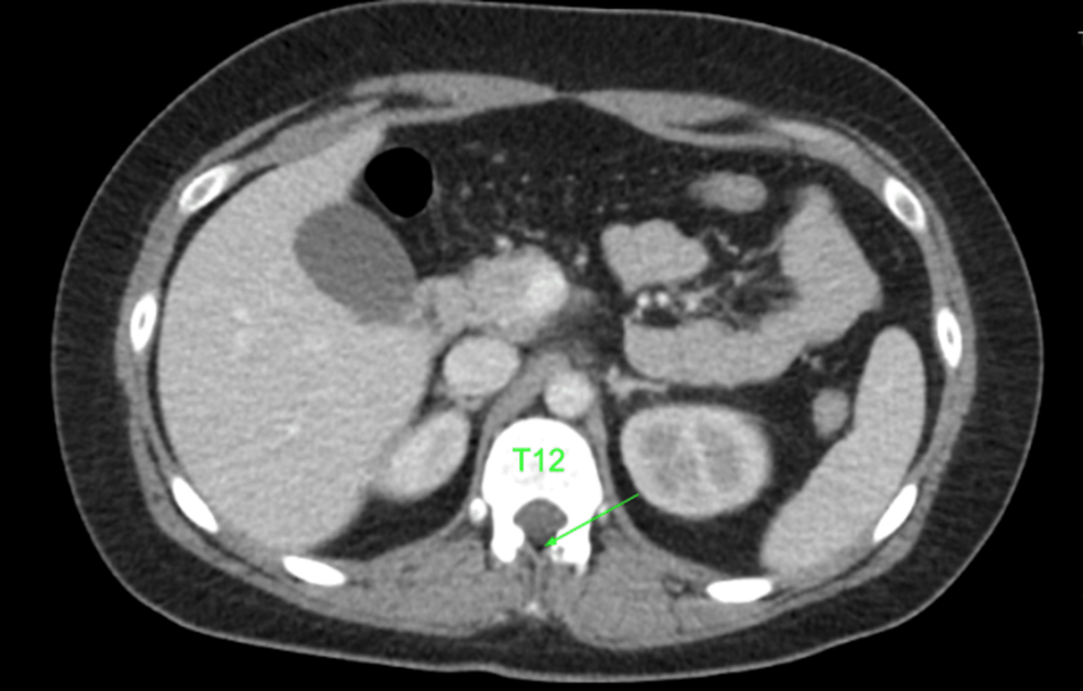 Transverse-computerized-tomography-scan-of-abdomen,-arrow-indicates-potential-epidural-space