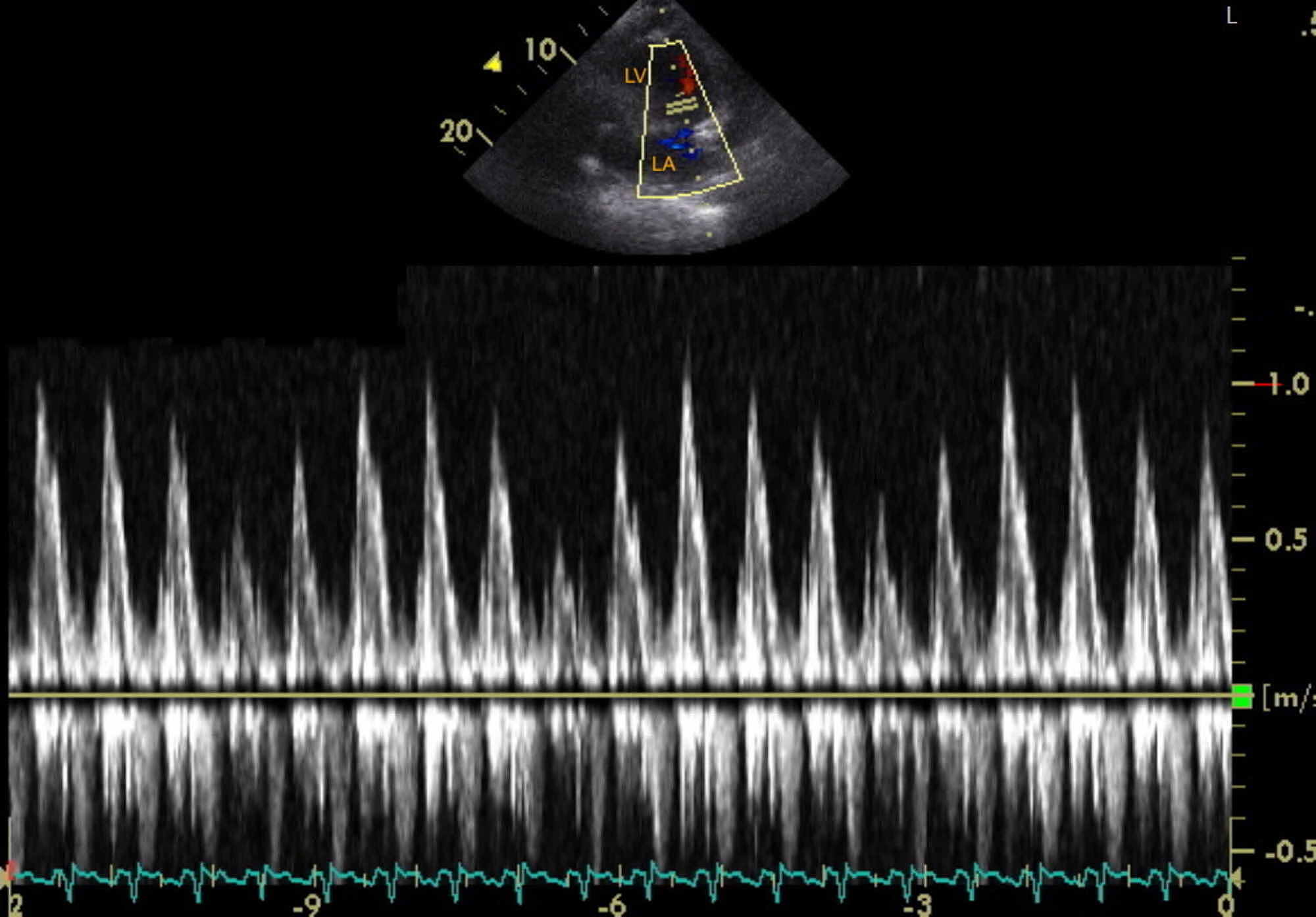 Cureus Atypical Cardiac Tamponade Manifesting as Left Ventricular