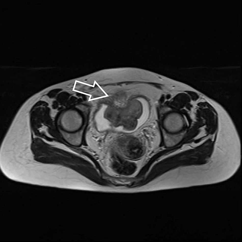 Radical Cystectomy And Ileal Conduit Diversion For Bladder Urothelial ...