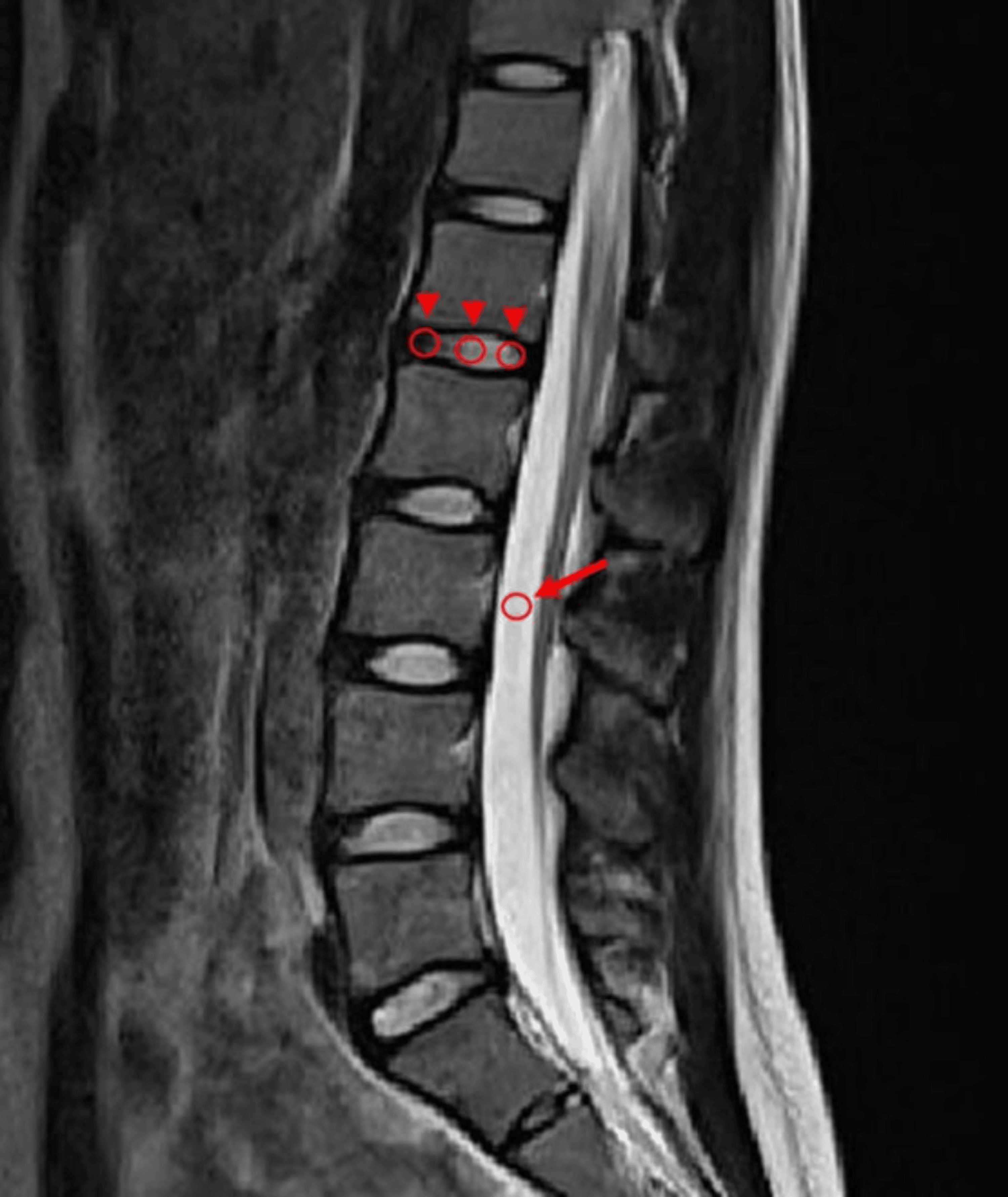 Quantitative Assessment of Intervertebral Disc Degeneration Using the ...