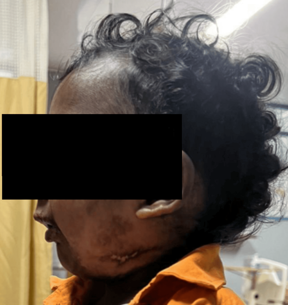 A-17-month-old-male-child-with-PRS