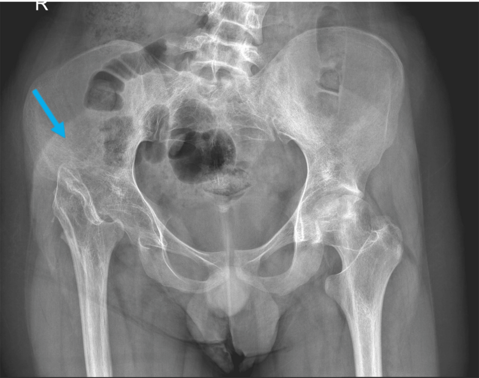 Total Hip Arthroplasty Following the Girdlestone Procedure in a Sickle