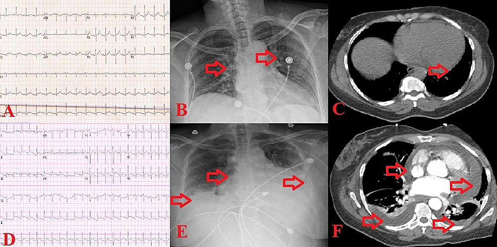Images-before-developing-the-pericardial-effusion-and-tamponade-(top-row,-Panels-A,-B-and-C),-and-after-(low-row,-Panels-D,-E-and-F).-Panel-A:-EKG-showing-sinus-tachycardia,-1-mm-ST-segment-elevation-in-inferior-leads.-Panel-B:-Chest-X-ray-showing-pulmonary-venous-congestion.-Panel-C:-Chest-CT-showing-mild-pericardial-effusion.-Panel-D:-EKG-showing-sinus-tachycardia,-1.5-mm-ST-segment-elevation-in-inferior-and-lateral-leads.-Panel-E:-Chest-X-ray-showing-left-lower-lobe-consolidation,-with-greater-left-than-right-pleural-effusion.-Panel-F:-Chest-CT-showing-expanding-pericardial-effusion,-and-mild-pleural-effusion.