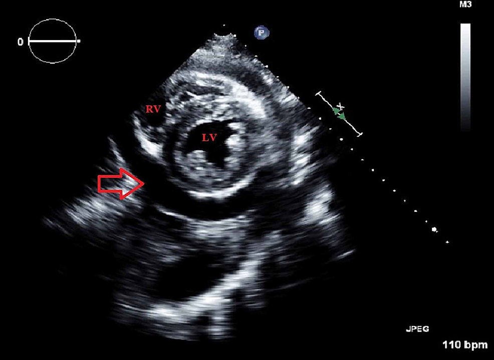 Short-axis-TEE-view,-showing-the-left-ventricle,-right-ventricle-and-a-moderate-to-large-pericardial-effusion-(arrow).