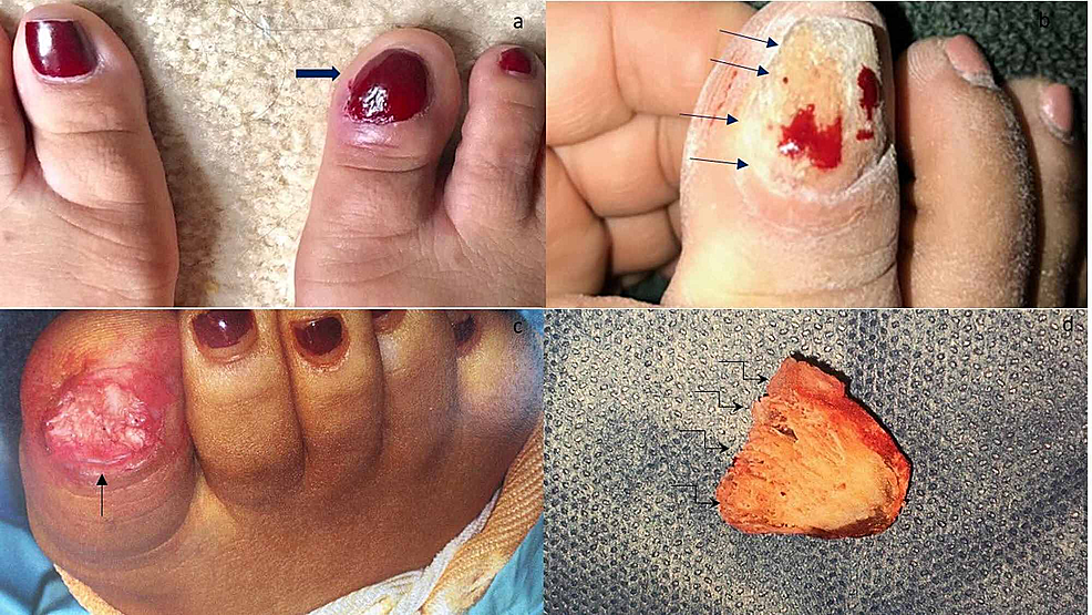 Onychomatricoma-of-the-right-great-toenail-of-a-43-year-old-woman-