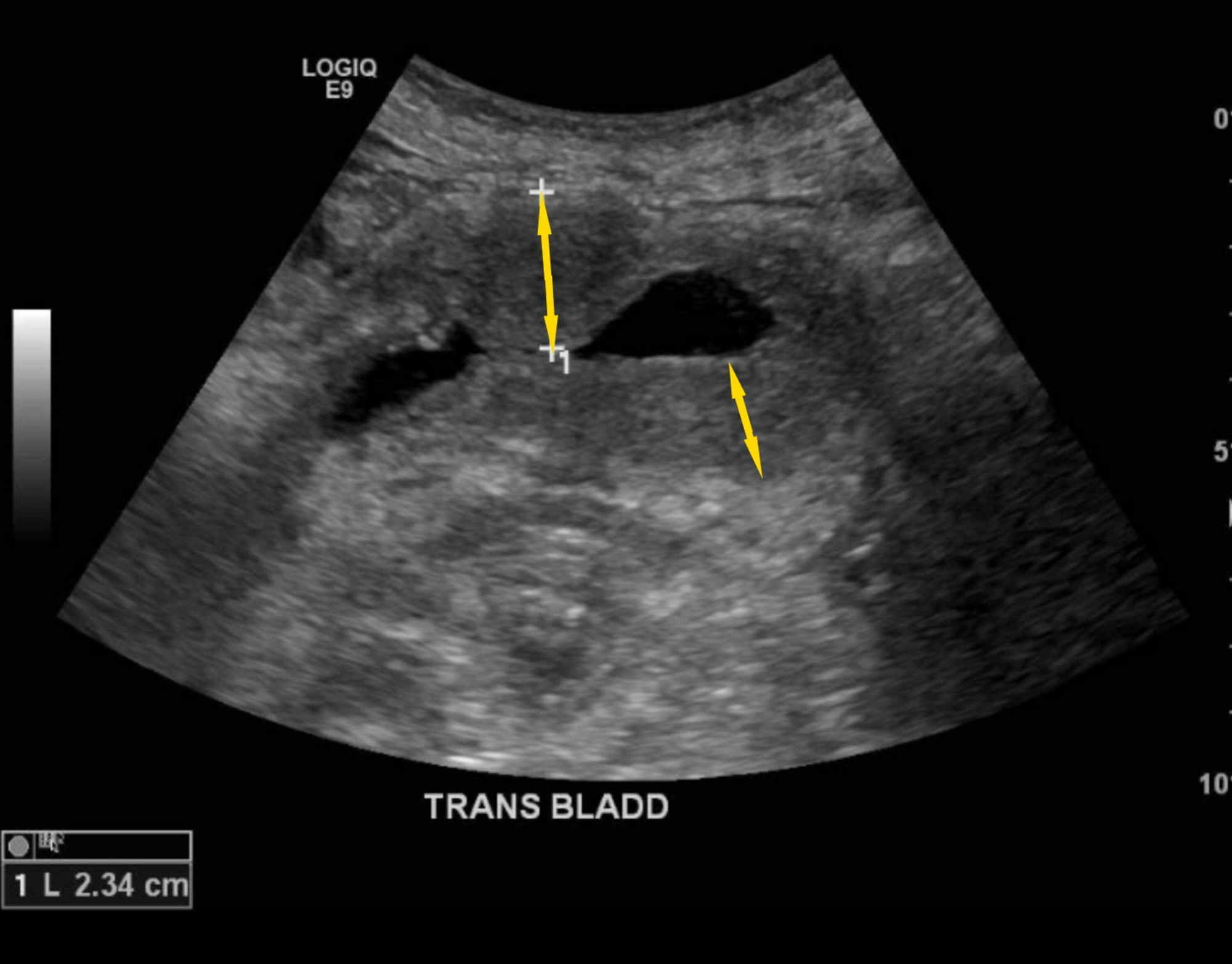 Thickening Of Bladder Wall