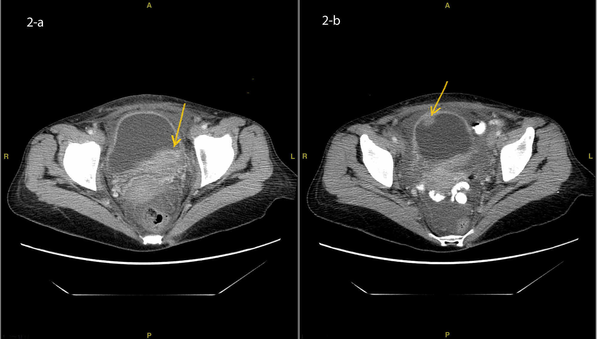 Cureus Hypereosinophilic Syndrome Multiorgan Involvement And Response To Imatinib 