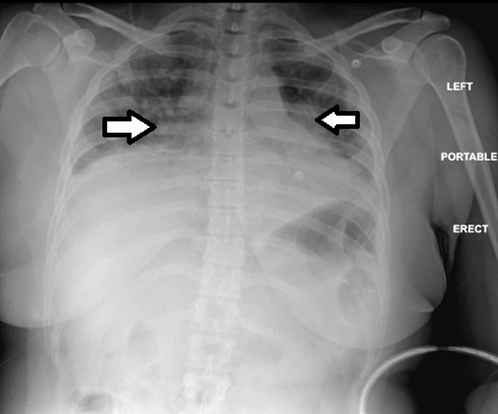Cureus AntiSignal Recognition Particle AntibodyAssociated Severe Interstitial Lung Disease