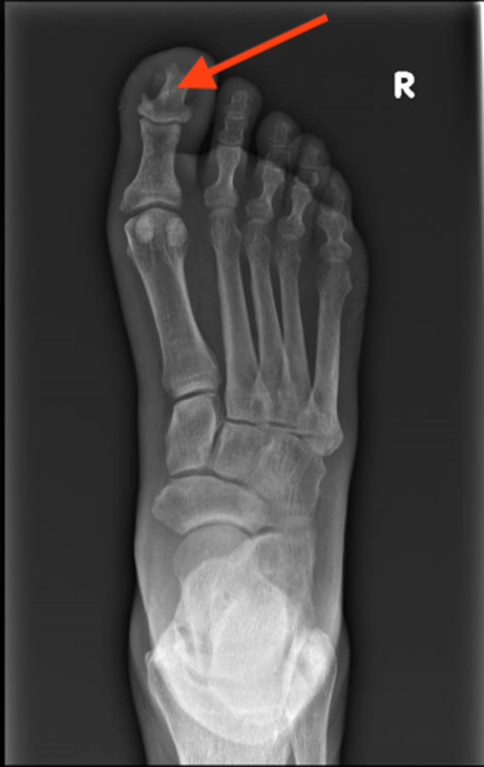 Cureus Four Curious Cases of ClosedIncision Negative Pressure