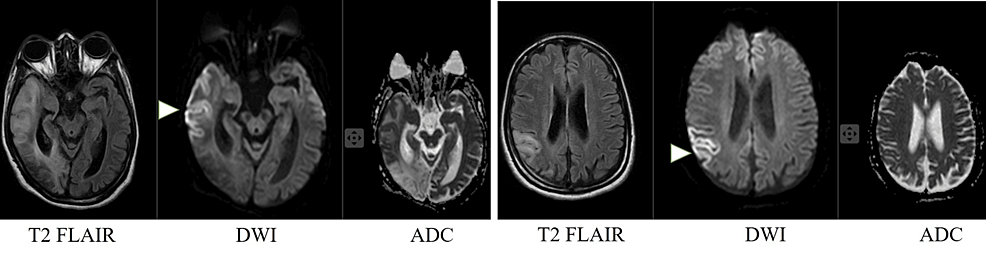 l carnitine seizures reddit Unveiling the Mitochondrial Mystery: A Case of Mitochondrial Encephalopathy With Lactic Acidosis and Stroke-Like Episodes glutathione soap Multi Pack:Pack Of 6 Chelation Therapy Clinic Near