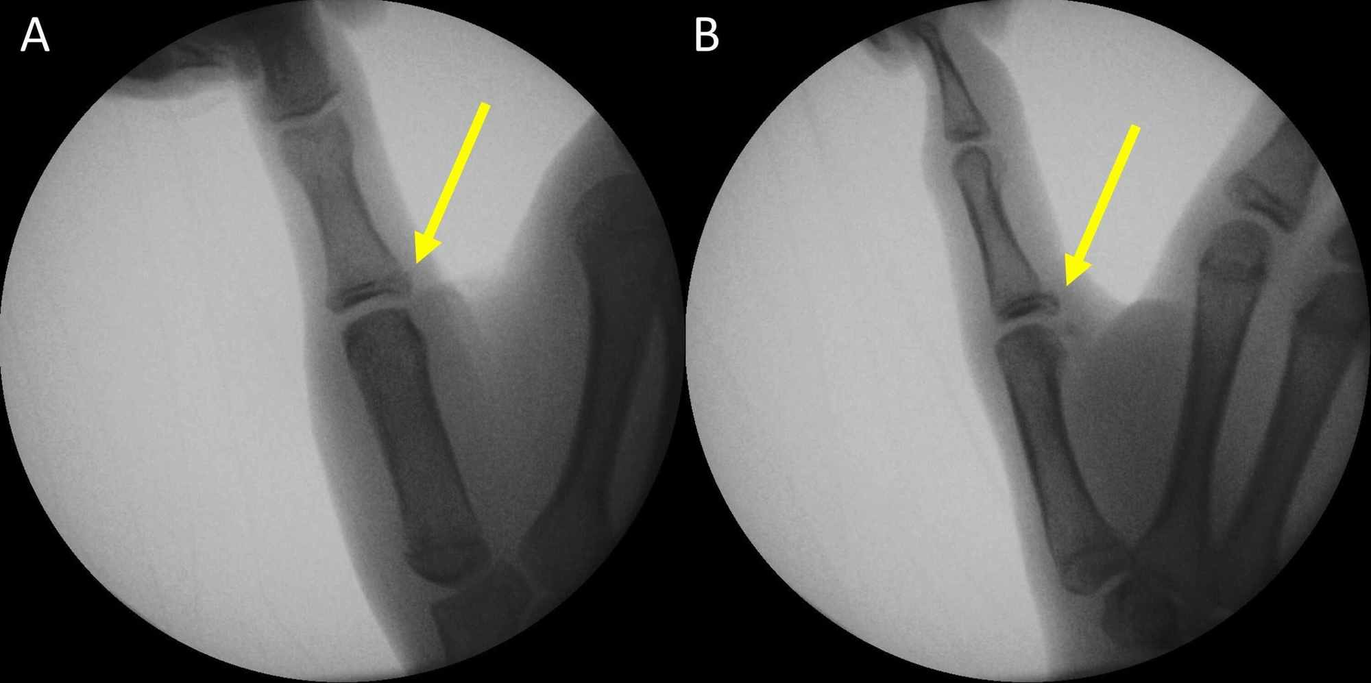 Cureus Transosseous Suture Fixation Of Avulsion Fracture Of The Ulnar