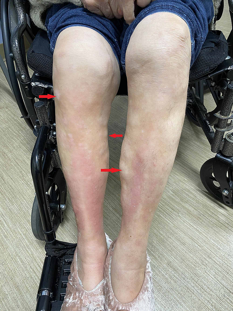 Cureus A Case Of Extensive Debilitating Generalized Morphea