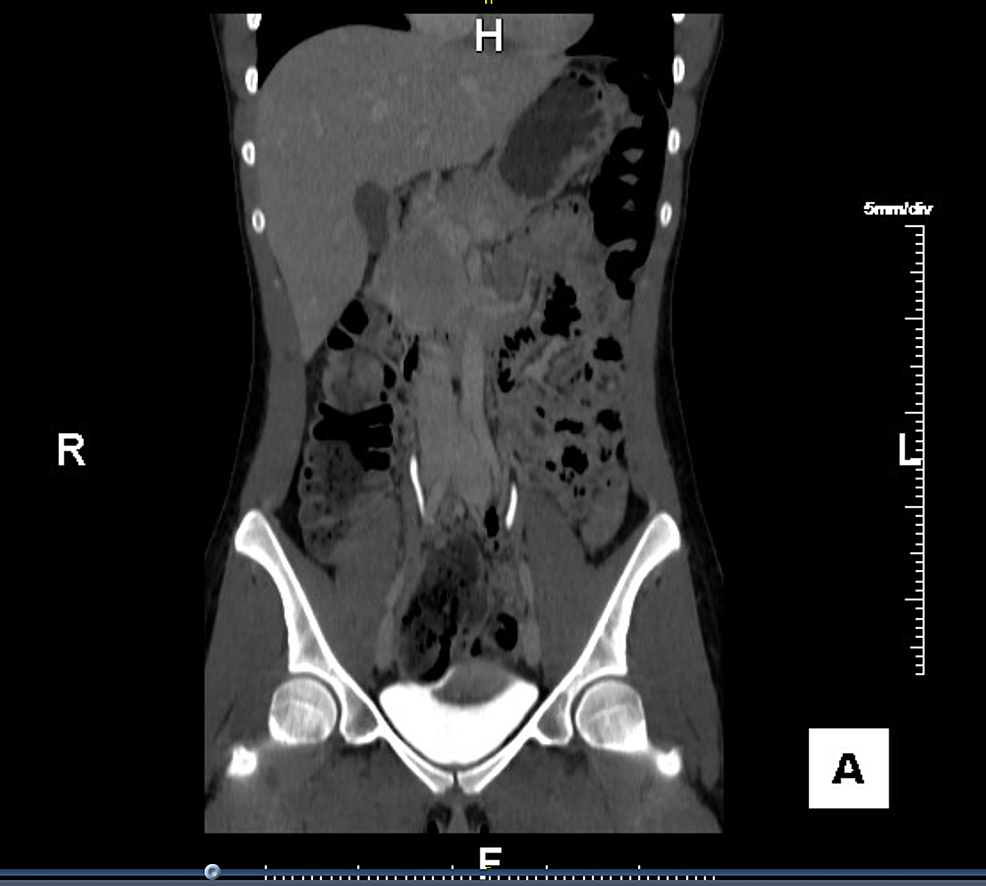 cureus-interstitial-cystitis-or-painful-bladder-syndrome-in-a