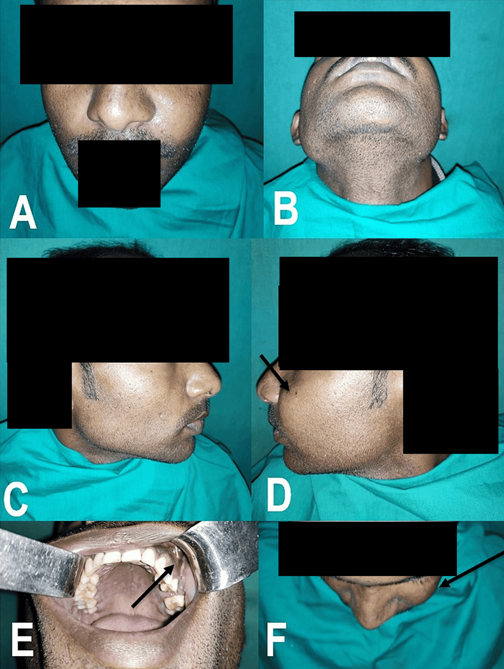 Postoperative Maxillary Cyst Following Maxillary Tooth Extraction: A Rare  Surgical Predicament | Cureus