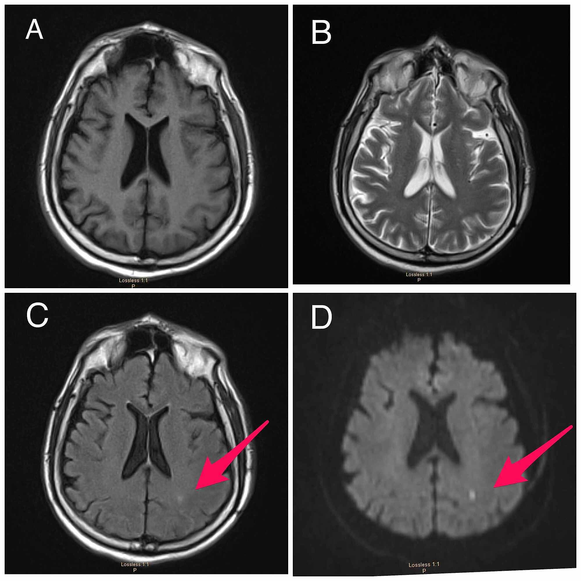 Cureus Neurological Complications of Coronavirus Disease