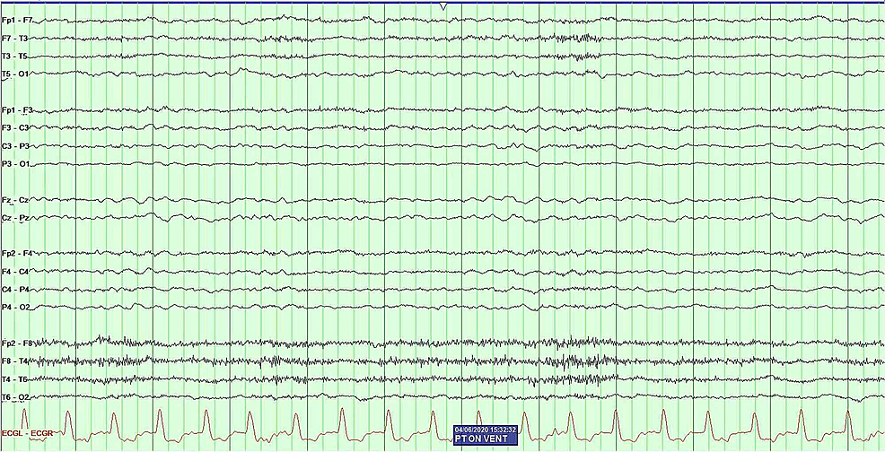 Electroencephalography-revealed-diffuse-slowing-and-no-evidence-of-epileptiform-abnormalities.