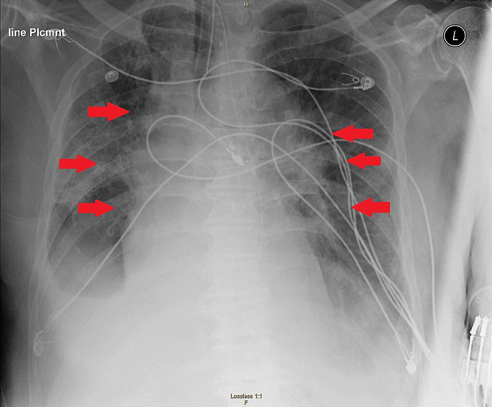 Chest-x-ray-demonstrating-multifocal-consolidations-concerning-for-multifocal-pneumonia.