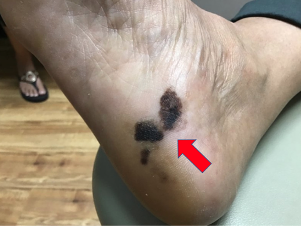 A-3.0-cm-x-1.5-cm-well-demarcated,-brown-to-black-patch-with-two-adjacent-smaller-brown-to-black-patches-with-scalloped-borders-on-the-right-plantar-surface.