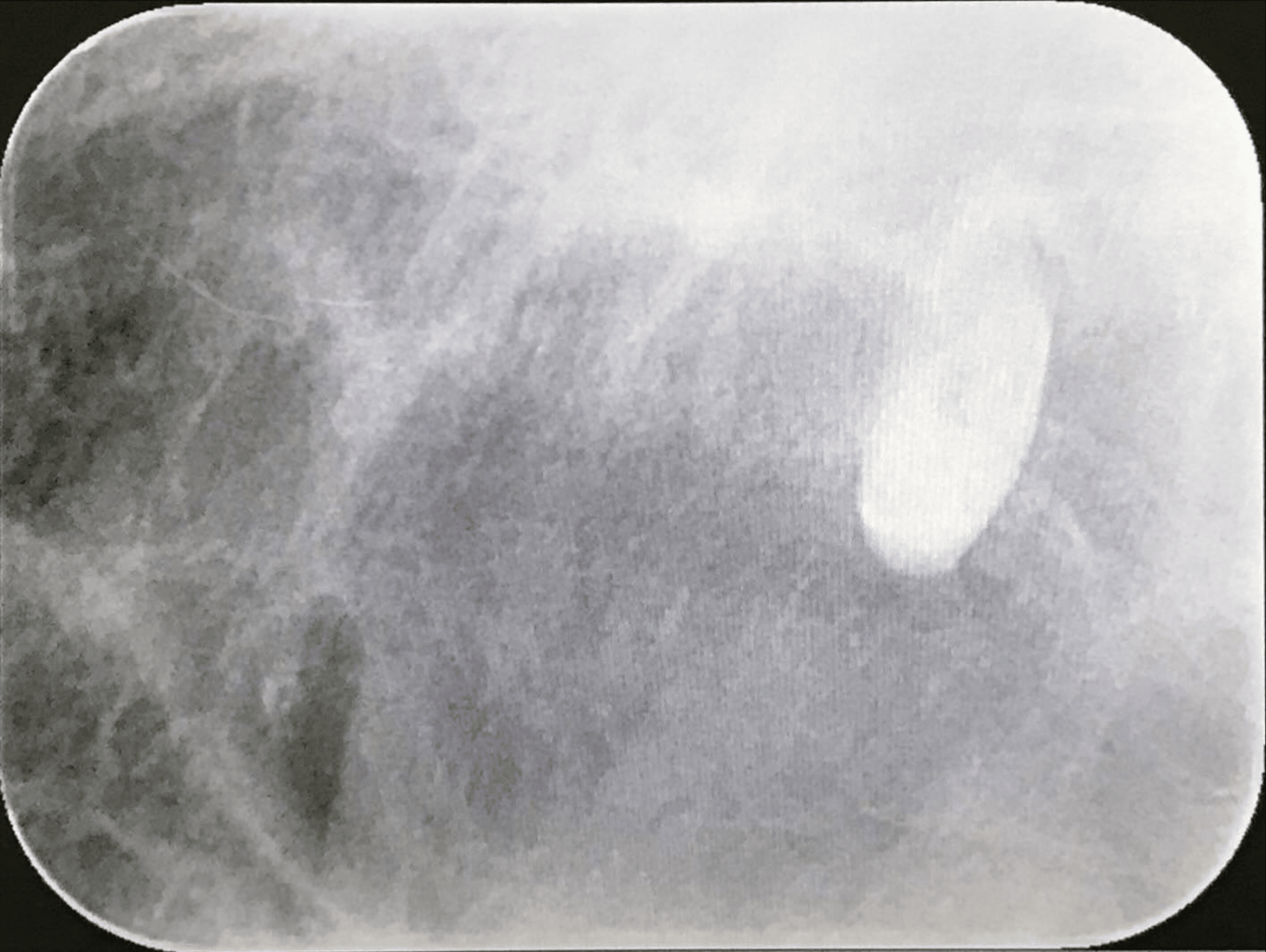 General Anesthesia for Patients With Cyclic Vomiting Syndrome and