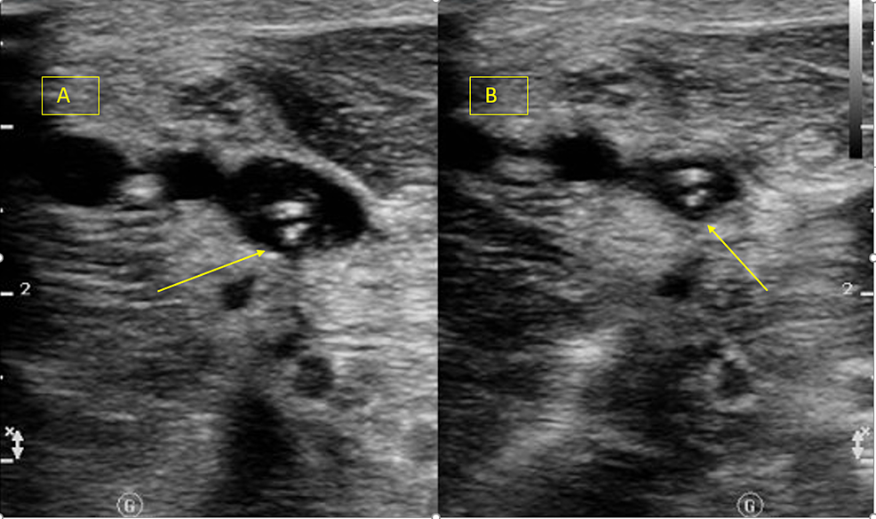 Cureus | Hughes Stovin Syndrome, a Rare Form of Behcet's Disease