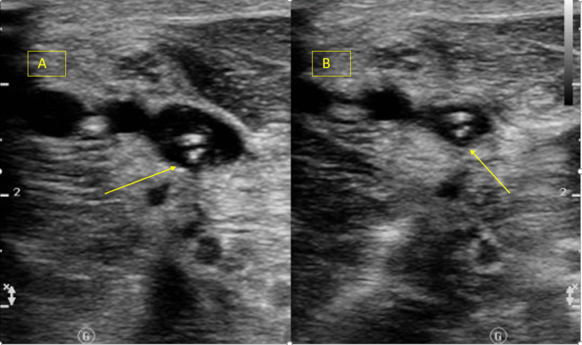 venous doppler ultrasound venous doppler ultrasound