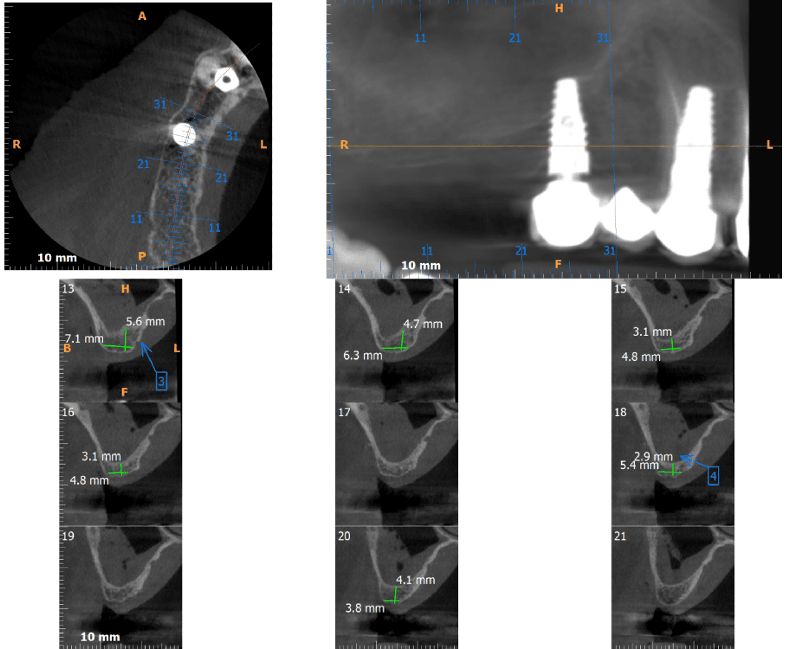 Short Implants And Indirect Sinus Lift Versus Direct Sinus Lift With Standard Length Implants A 2719