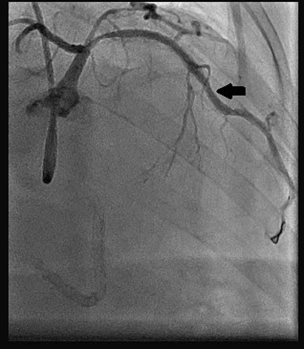 Cureus | Successful Management Of Coronary In-Stent Restenosis: A Case ...