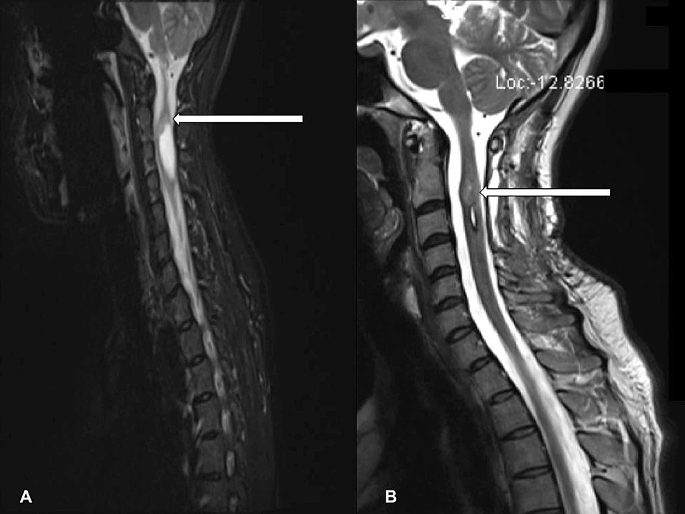 Cureus A Pain In The Neck A Case Of Intramedullary Spinal Ependymoma